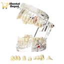 Tipodonto Didáctico Patologías-tx Implantes