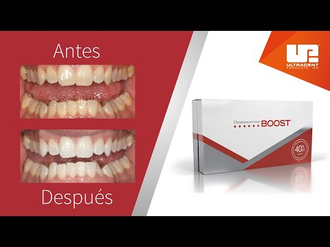 BLANQUEAMIENTO OPALESCENSE BOOST C/1, OPALDAM Y 3 PUNTAS